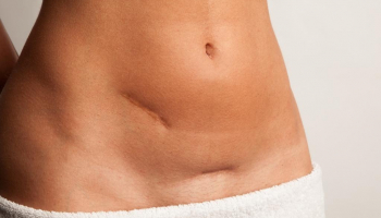 Cicatrices, adhérences : comment les traiter ?